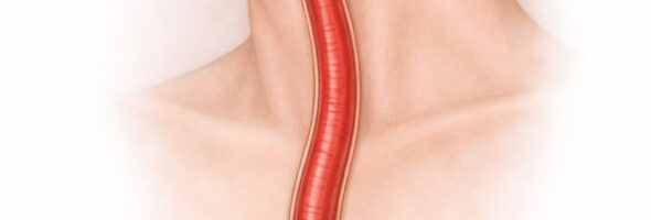 Desensibilización y esofagitis eosinofílica